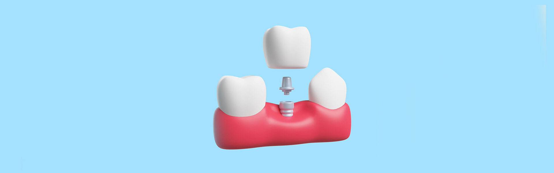 The Different Types of Dental Implants