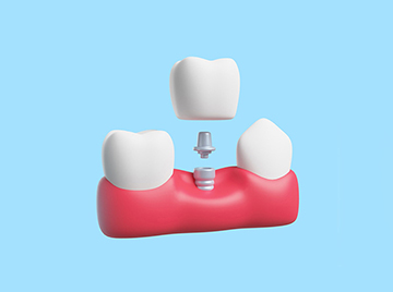 The Different Types of Dental Implants