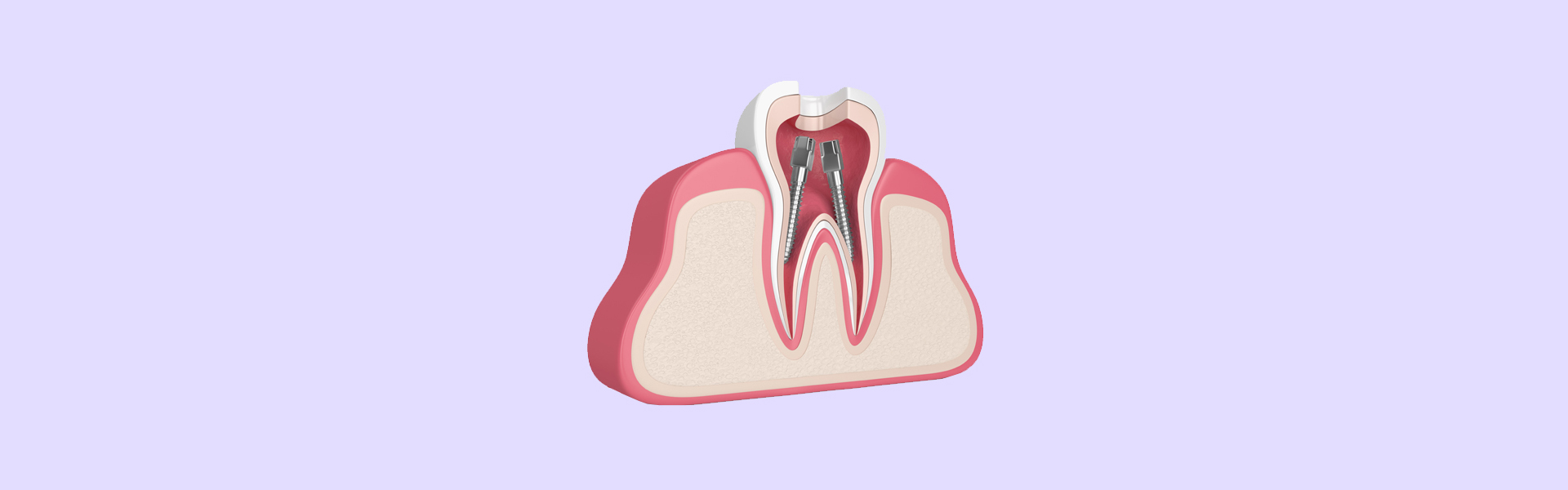 Root Canal Therapy