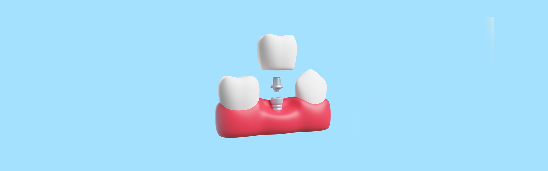 The Ultimate Guide to Dental Implants