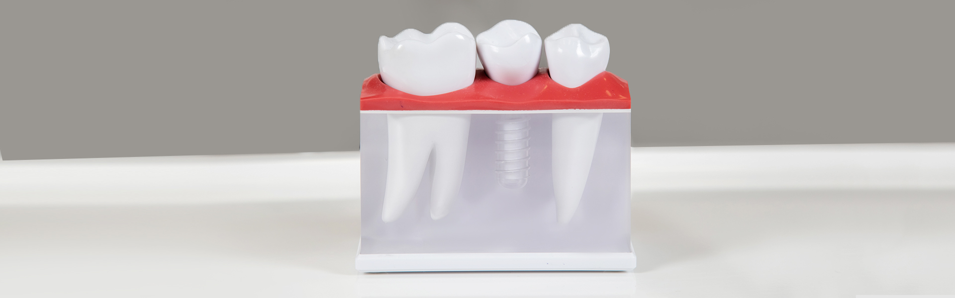 The Long-Term Benefits of Dental Implants on Your Oral Health