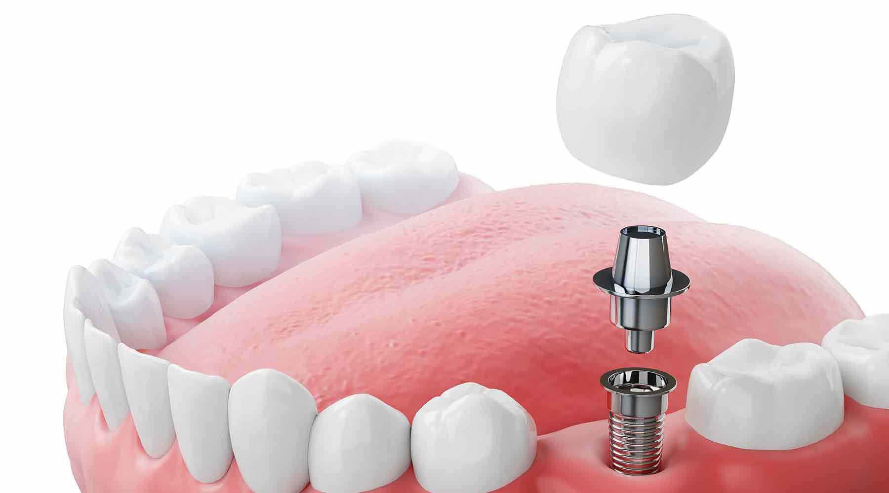 Dental-Implants-in-Sugar-Land-Texas