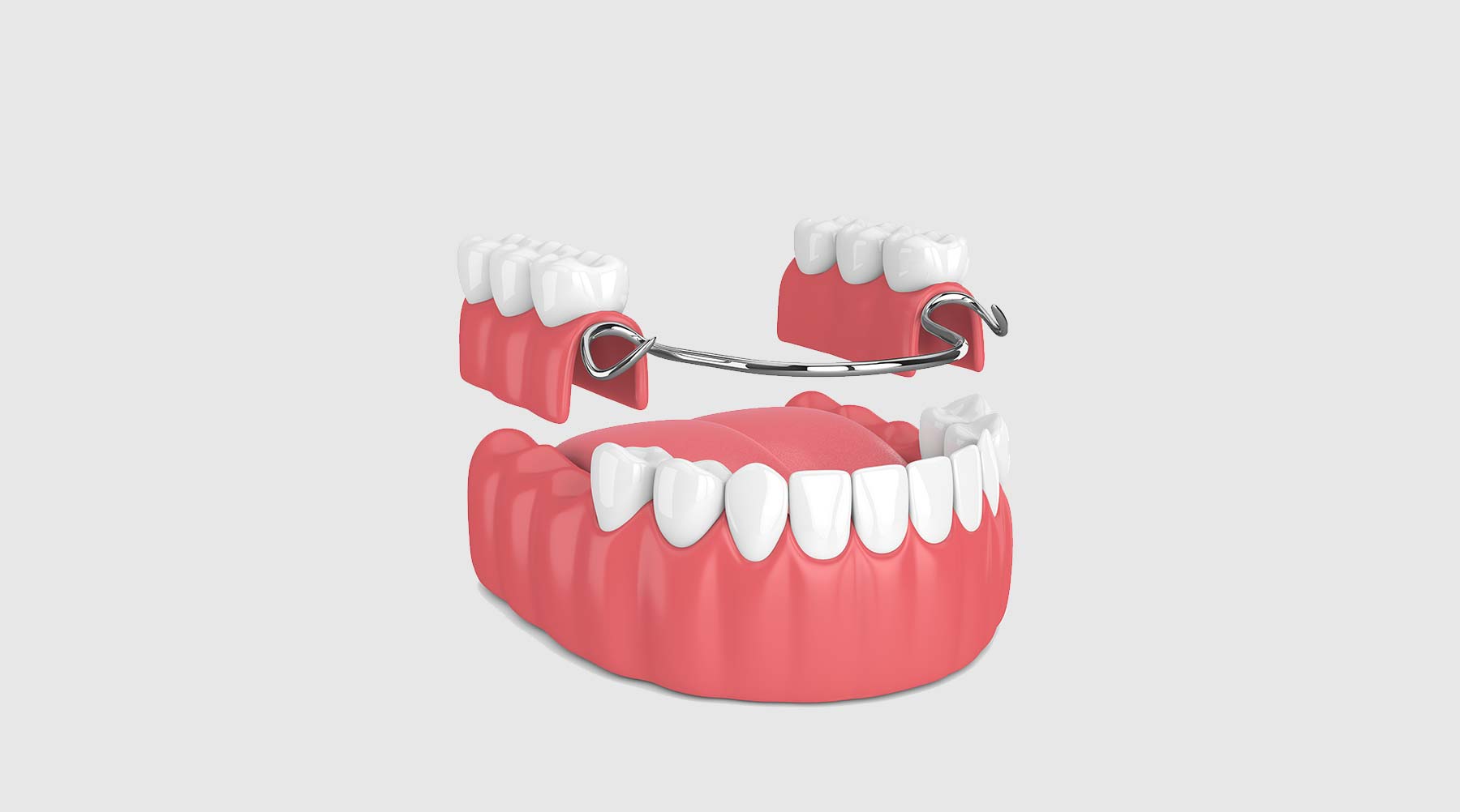 Partial Denture