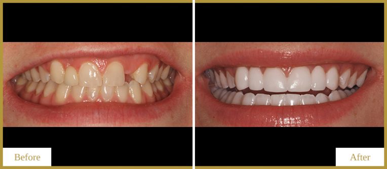 Bridges-and-Teeth-Whitening