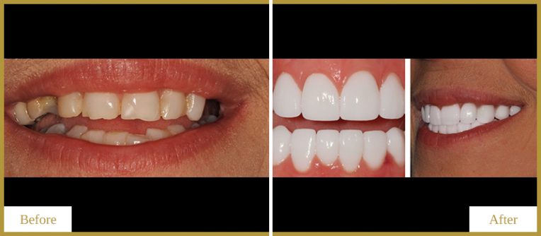 Crowns-and-Removable-Partial-Denture-1