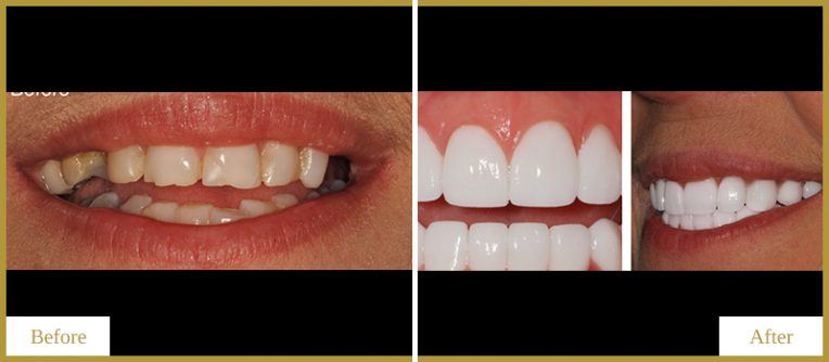 Crowns and Removable Partial Denture