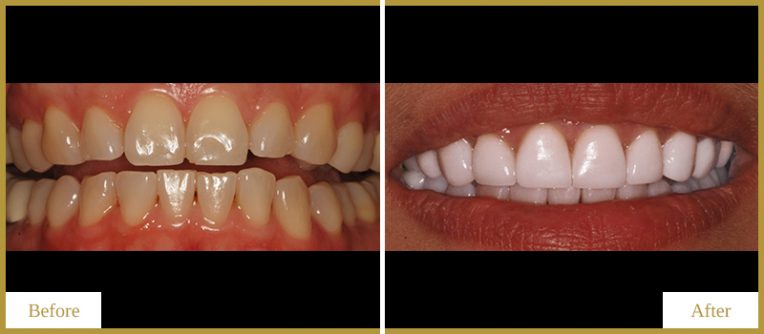 Crowns-and-Veneers-1