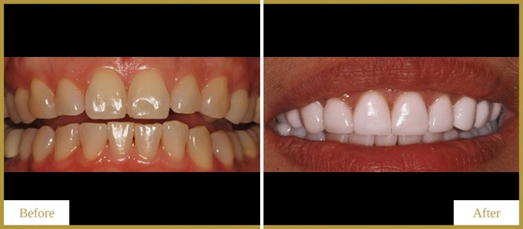 Crowns-and-Veneers