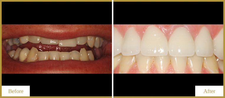 Crowns-on-Upper-Teeth