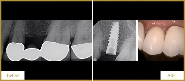 Implant-and-Crowns-1