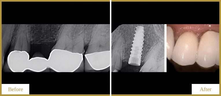 Implant-and-Crowns