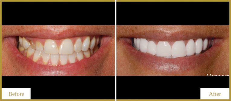 Bridge and Veneers