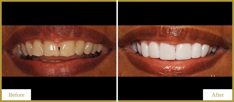 Veneers-and-Teeth-Whitening-1