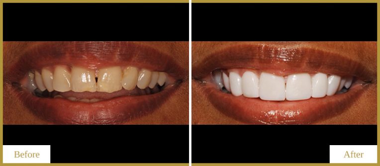 Veneers-and-Teeth-Whitening